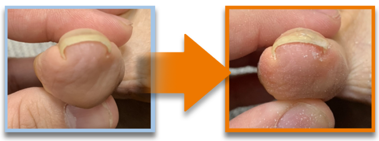 Ingrown-Nail-Beauty-Salon-Sendai-City