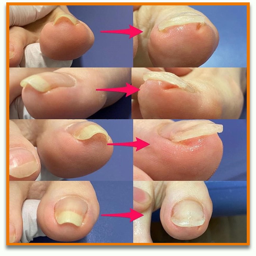Ingrown-Nail-Beauty-Salon-Sendai-City