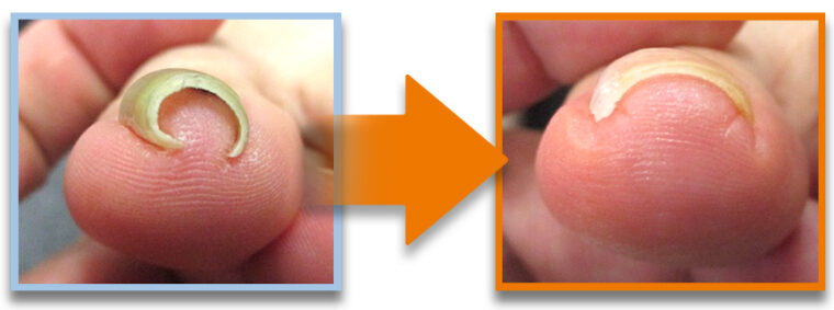Ingrown-Nail-Beauty-Salon-Sendai-City