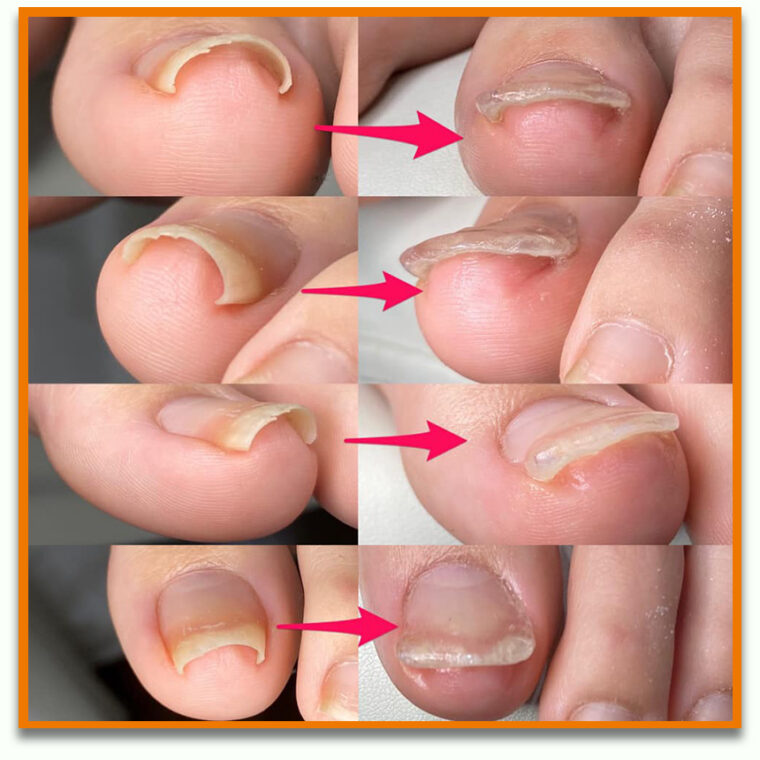 Ingrown-Nail-Beauty-Salon-Sendai-City