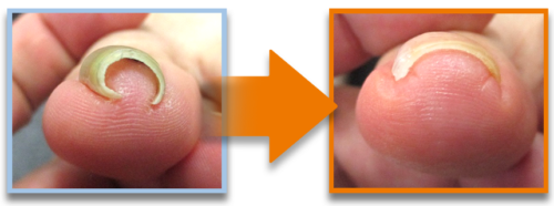 Ingrown-Nail-Beauty-Salon-Sendai-City
