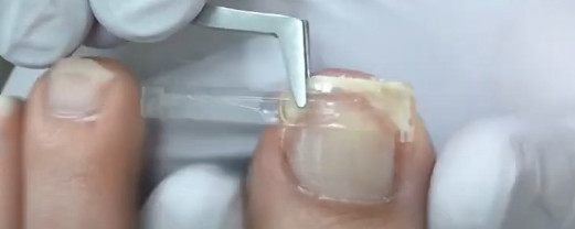 Ingrown-Nail-Beauty-Salon-Sendai-City