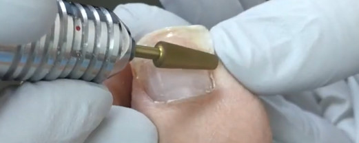 Ingrown-Nail-Beauty-Salon-Sendai-City