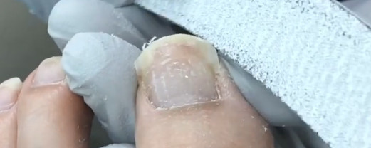 Ingrown-Nail-Beauty-Salon-Sendai-City