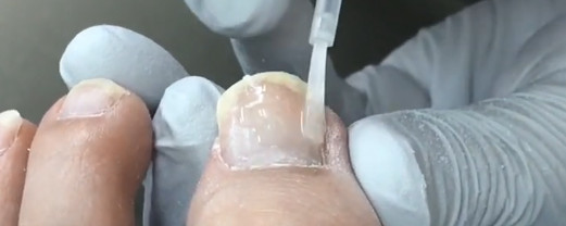 Ingrown-Nail-Beauty-Salon-Sendai-City