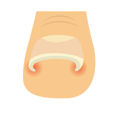 Ingrown-Nail-Beauty-Salon-Sendai-City