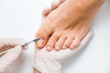 Ingrown-Nail-Beauty-Salon-Sendai-City