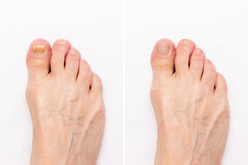 Ingrown-Nail-Beauty-Salon-Sendai-City